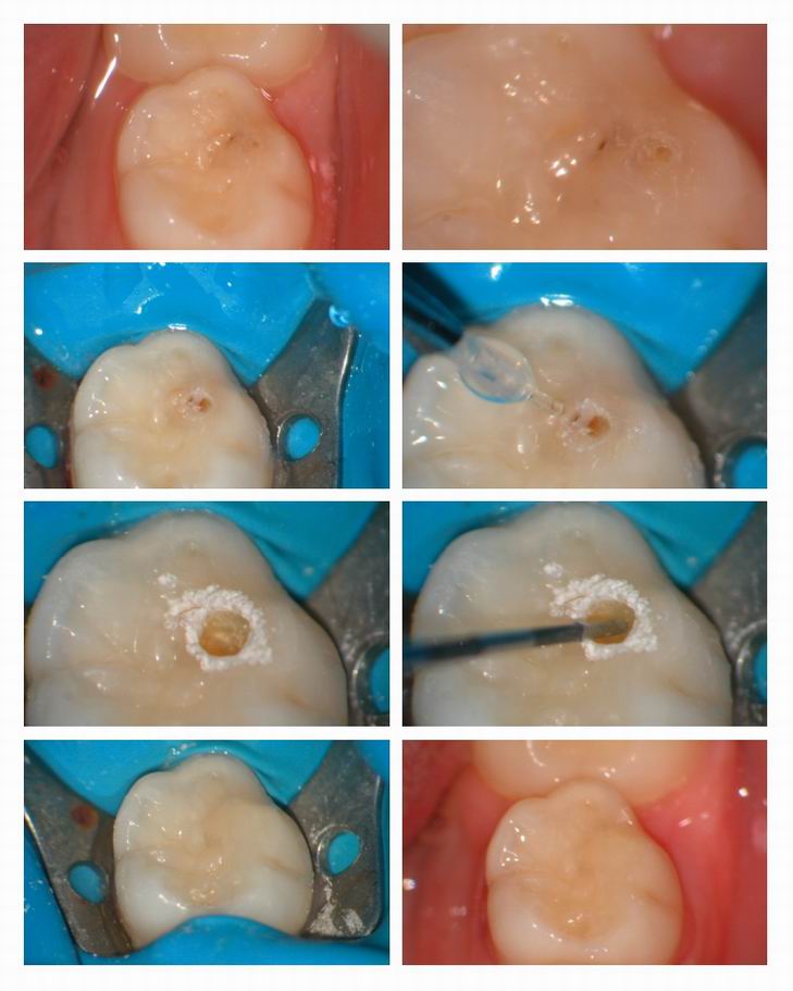 Resize of Pediatric Occlusal caries.jpg